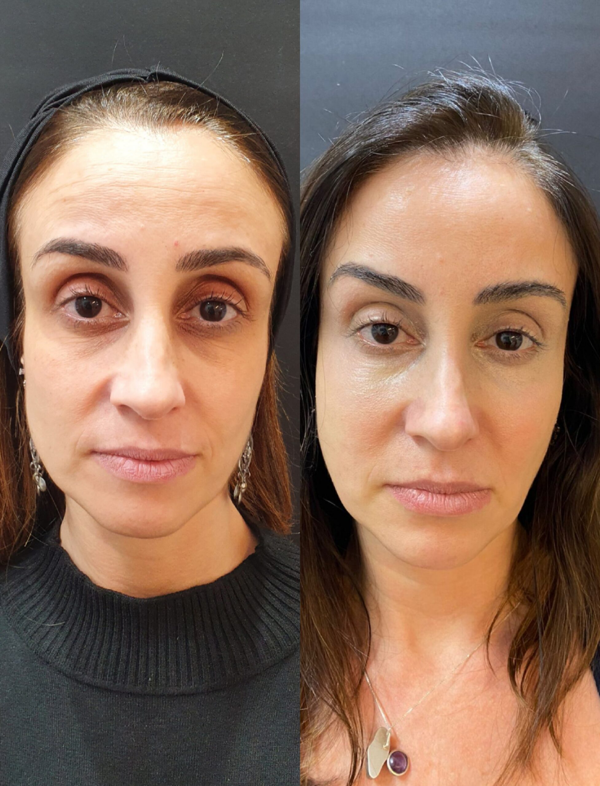 Transforme sua pele com nosso peeling rejuvenescedor sem agulhas: resultados visíveis, rejuvenescimento natural e total segurança. Pele revitalizada, sem dor nem traumas.