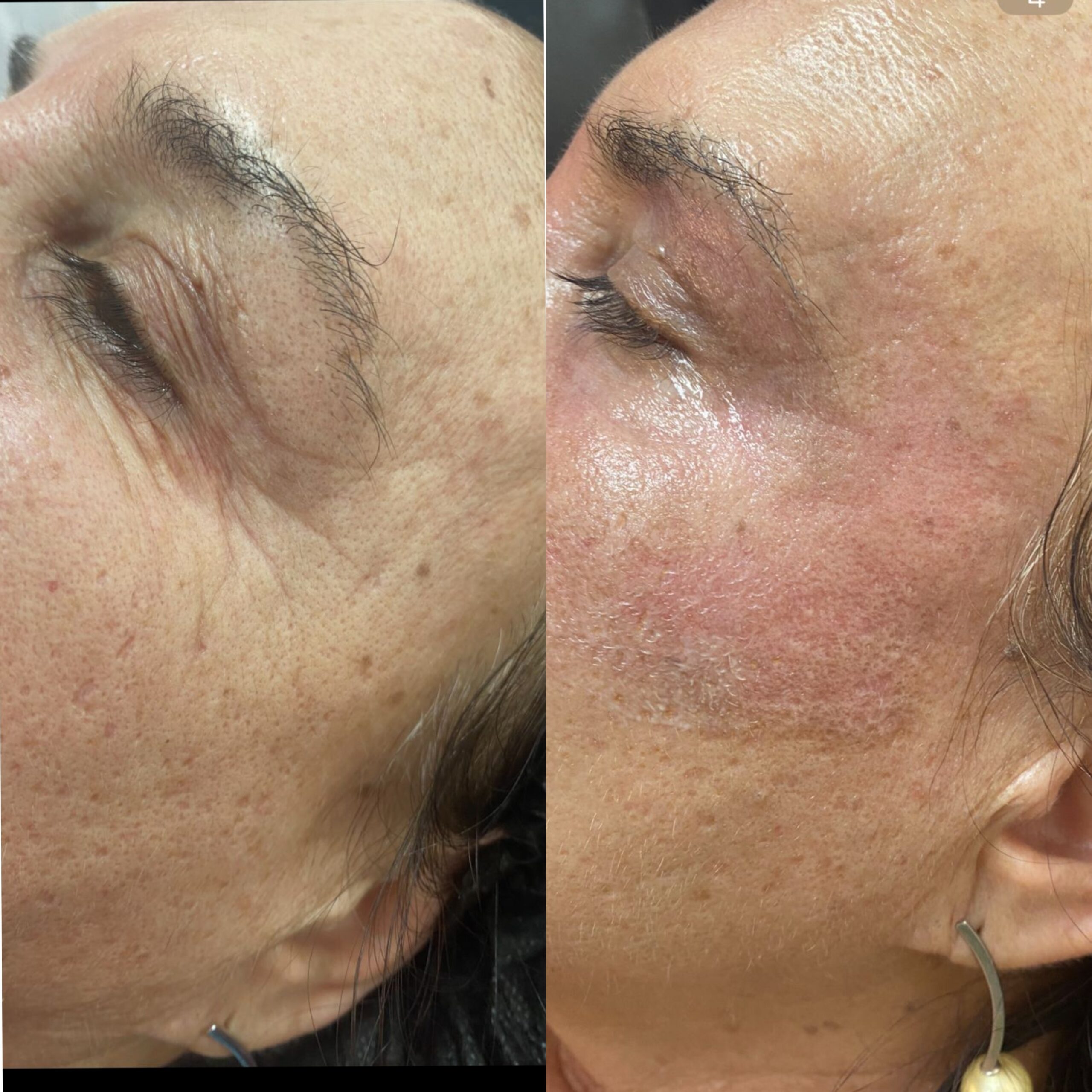 Transforme sua pele com nosso peeling rejuvenescedor sem agulhas: resultados visíveis, rejuvenescimento natural e total segurança. Pele revitalizada, sem dor nem traumas.