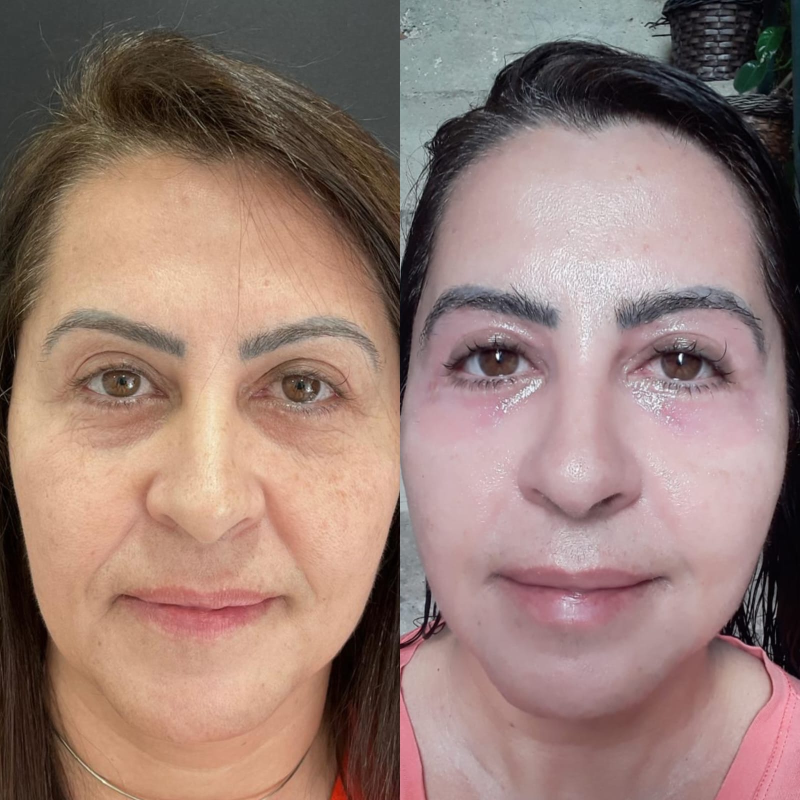 Transforme sua pele com nosso peeling rejuvenescedor sem agulhas: resultados visíveis, rejuvenescimento natural e total segurança. Pele revitalizada, sem dor nem traumas.