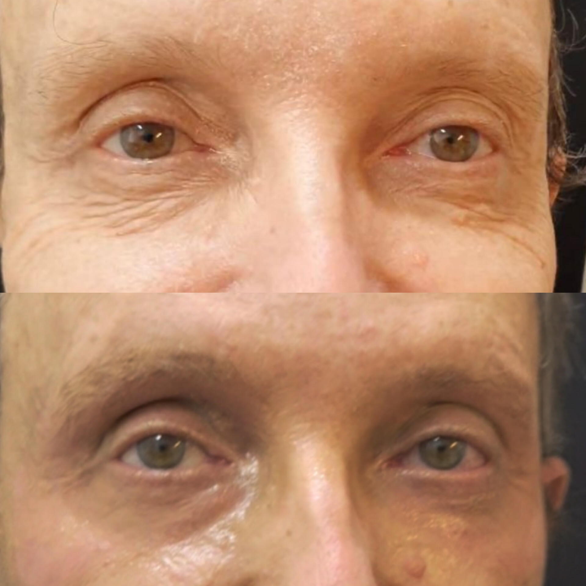 Transforme sua pele com nosso peeling rejuvenescedor sem agulhas: resultados visíveis, rejuvenescimento natural e total segurança. Pele revitalizada, sem dor nem traumas.