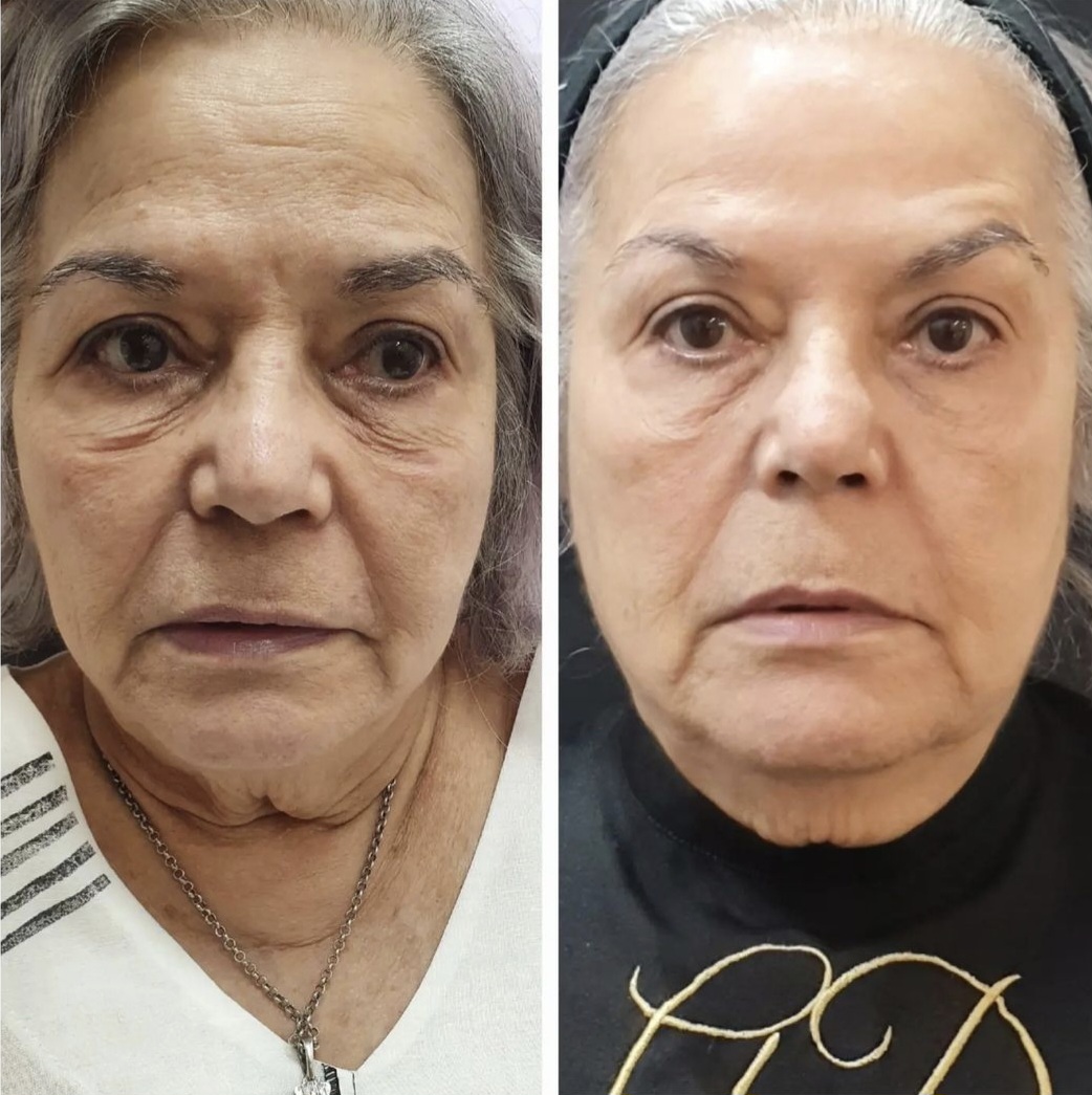 Antes e Depois - Destri Elevare