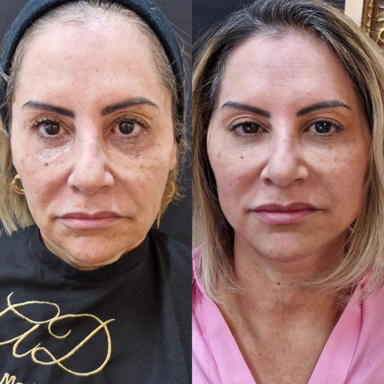 Transforme sua pele com nosso peeling rejuvenescedor sem agulhas: resultados visíveis, rejuvenescimento natural e total segurança. Pele revitalizada, sem dor nem traumas.