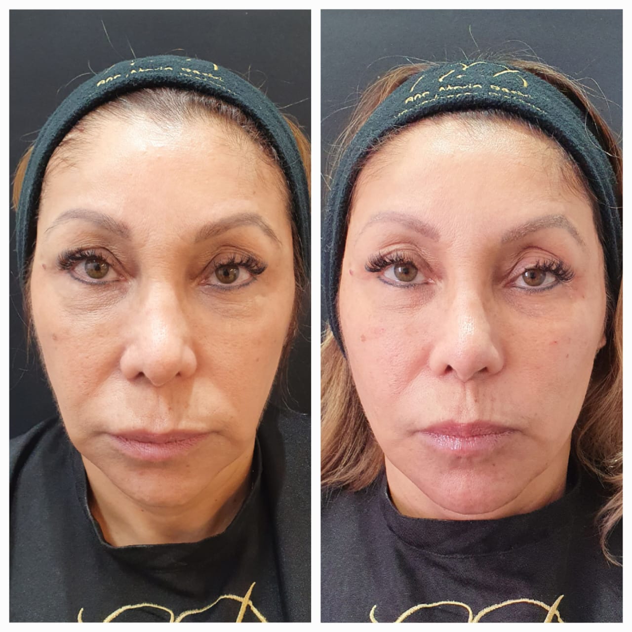 Antes e Depois - Destri Elevare