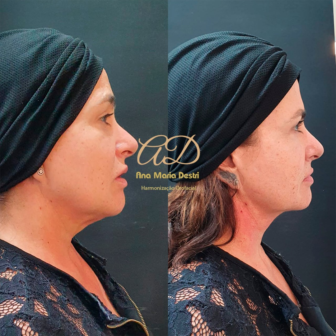 Antes e Depois - Destri Elevare